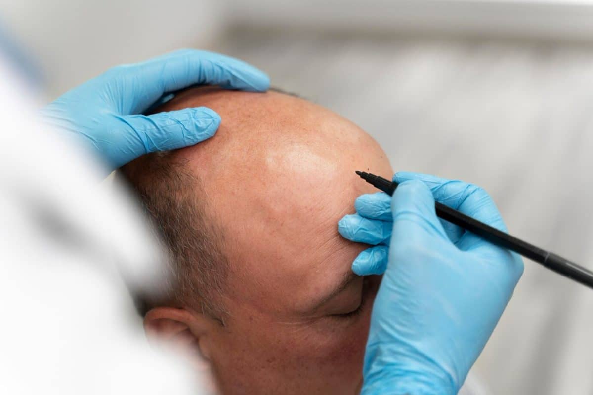 How to Save on Hair Transplant Costs