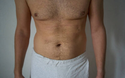 Is Gynecomastia Surgery Right for Me?