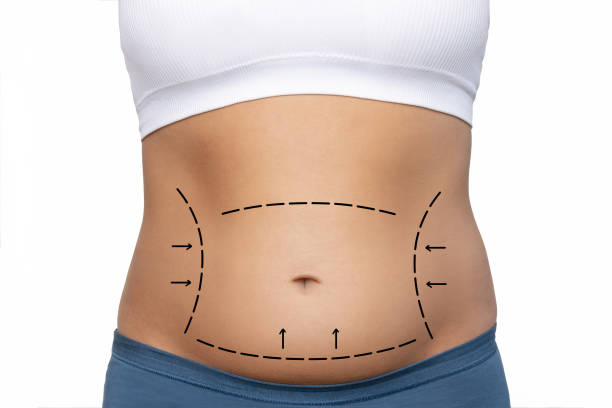 Is Liposuction a Permanent Solution?