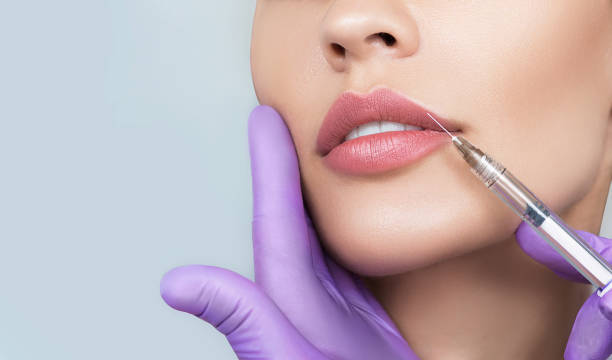 Is Russian Lip Fillers  Right for You