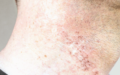 Laser Hair Removal: No More Razor Bumps or Nicks
