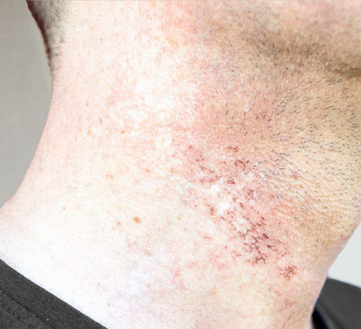 Laser Hair Removal No More Razor Bumps or Nicks