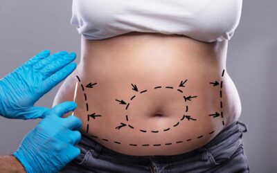 Laser Liposuction for Back Fat: Does It Work