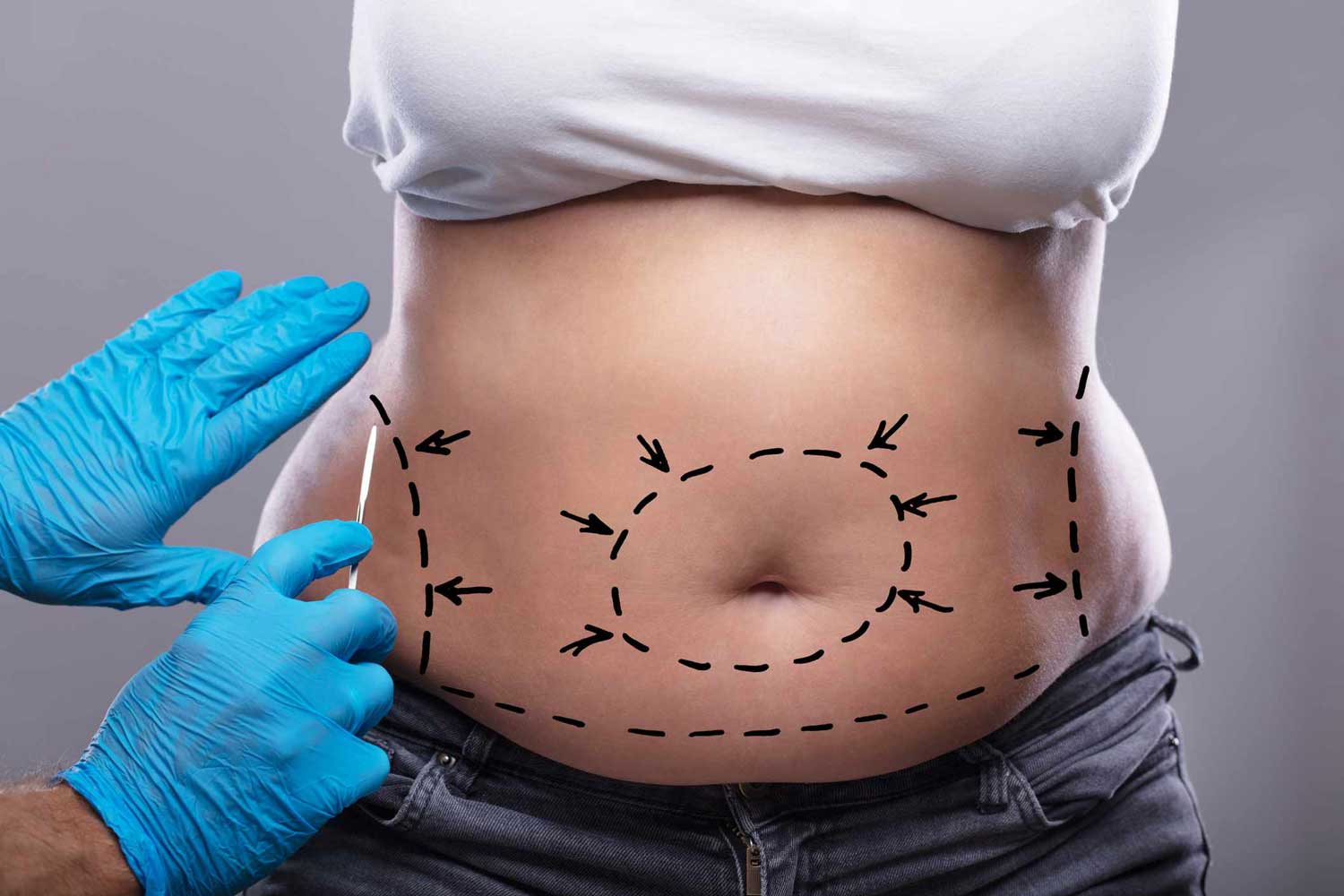 Laser Liposuction for Back Fat Does It Work