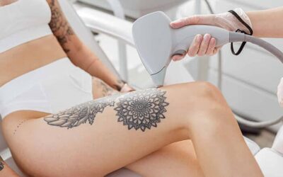 Laser Tattoo Removal: Is It Better Than Cover-Up