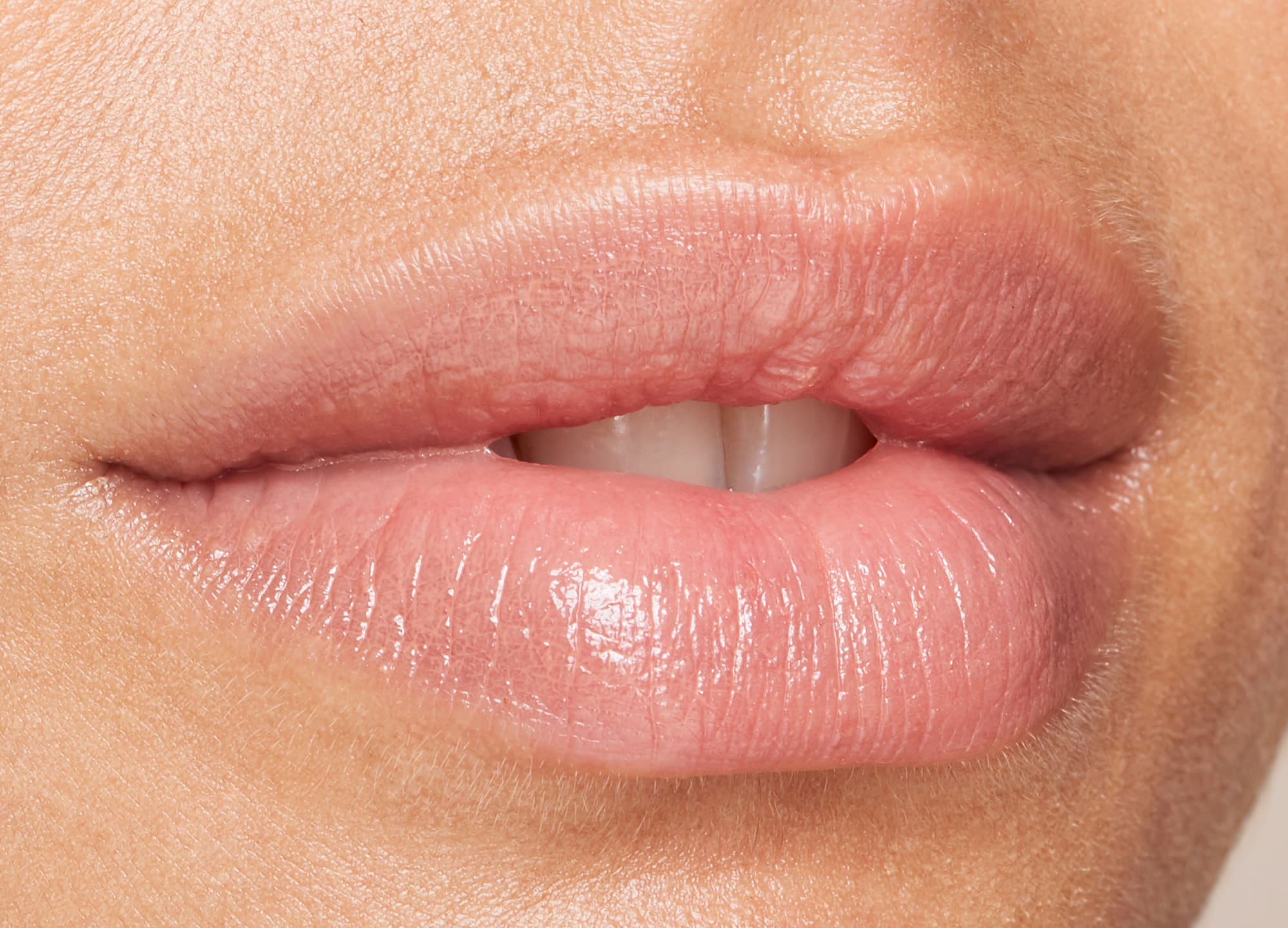 Light Touch Volumization with Volbella Fillers