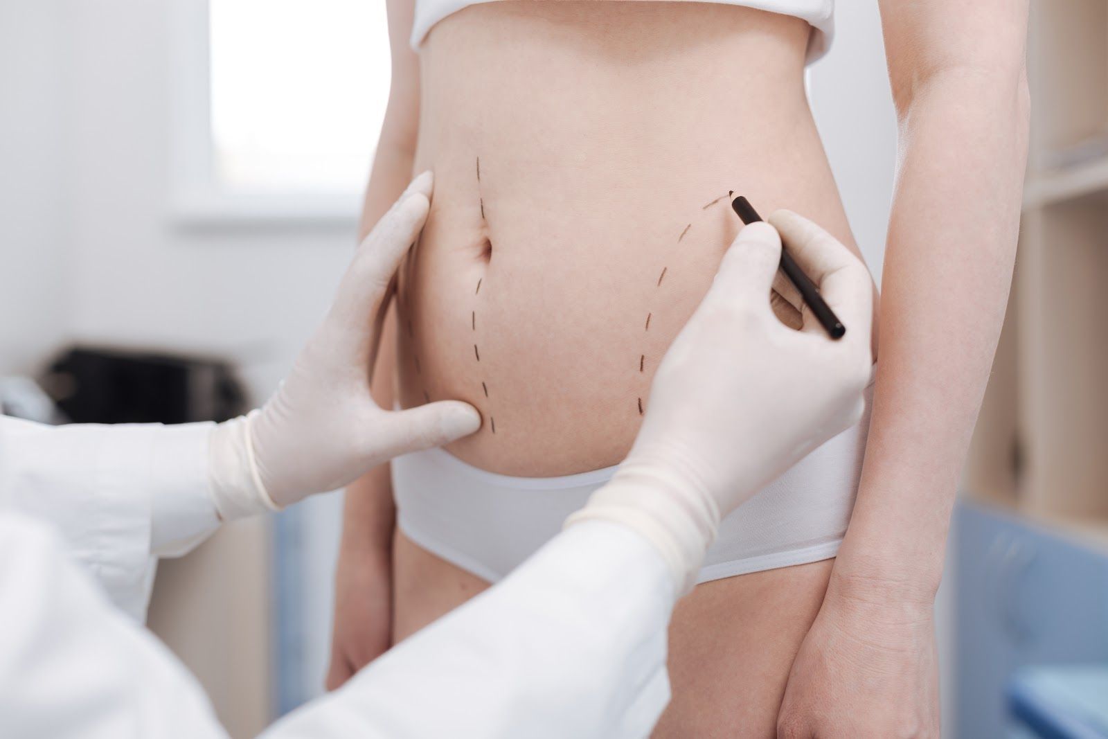 Liposuction Scars What They Look Like and How to Minimize Them