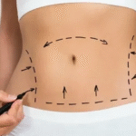 Liposuction surgery in Dubai
