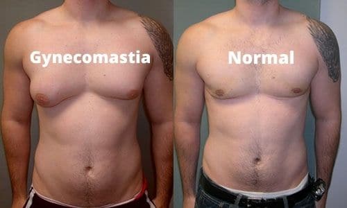 gynecomastia surgery in islamabad