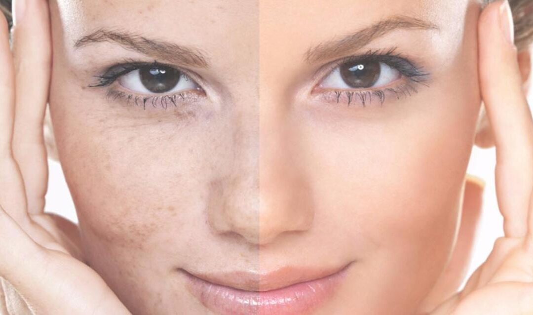Melasma Treatment: Tackle Stubborn Spots Gently