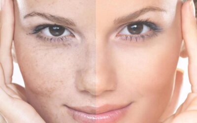 Melasma Treatment: Tackle Stubborn Spots Gently