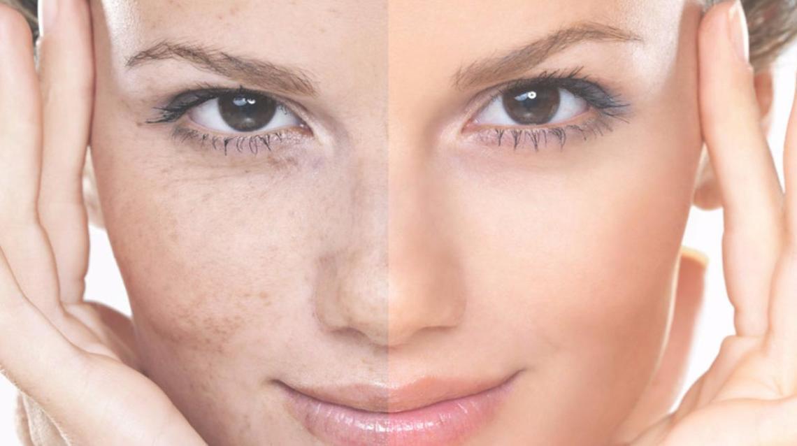 Melasma Treatment Tackle Stubborn Spots Gently