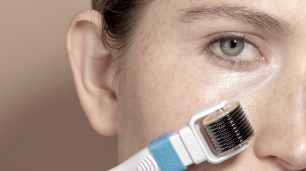 Micro-needling for acne scars: Healing phases