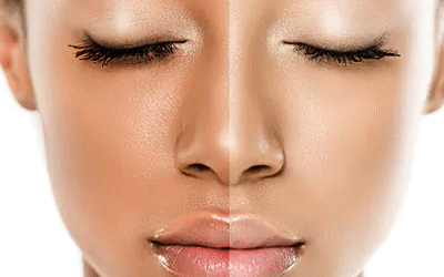 Is It Possible to Lighten Skin Permanently?