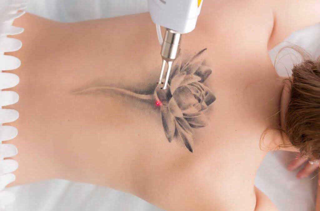 Reclaim Your Skin: Why More People Are Choosing to Erase Ink
