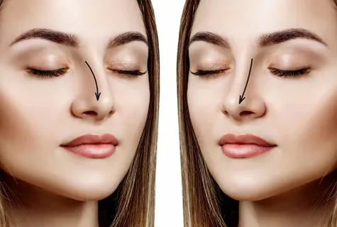 Understanding Revision Rhinoplasty: Second Chances for Nose Reshaping in Dubai
