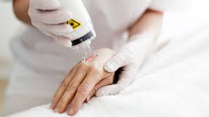 Scar Laser Treatment for Burn Scars: Options Today