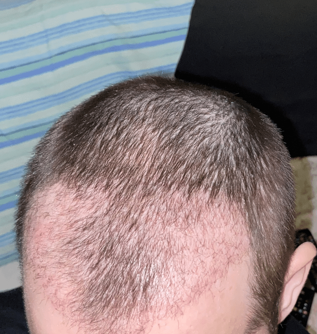 The Best Crown Hair Transplant Services Explained