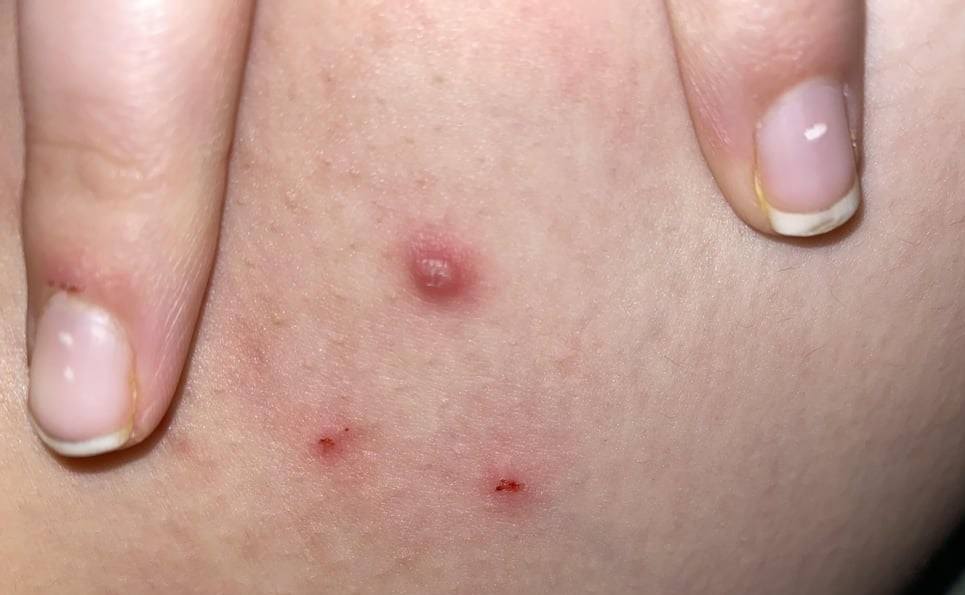 The Ideal Age for Warts Removal Surgery