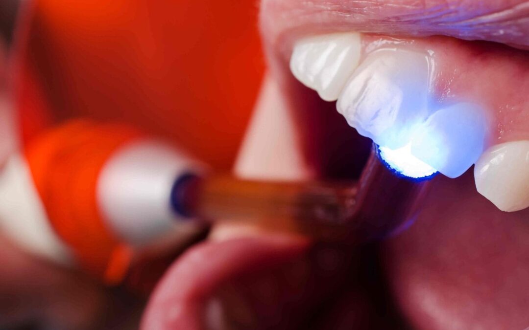 Tooth Sensitivity After Fillings: What’s Normal and What’s Not
