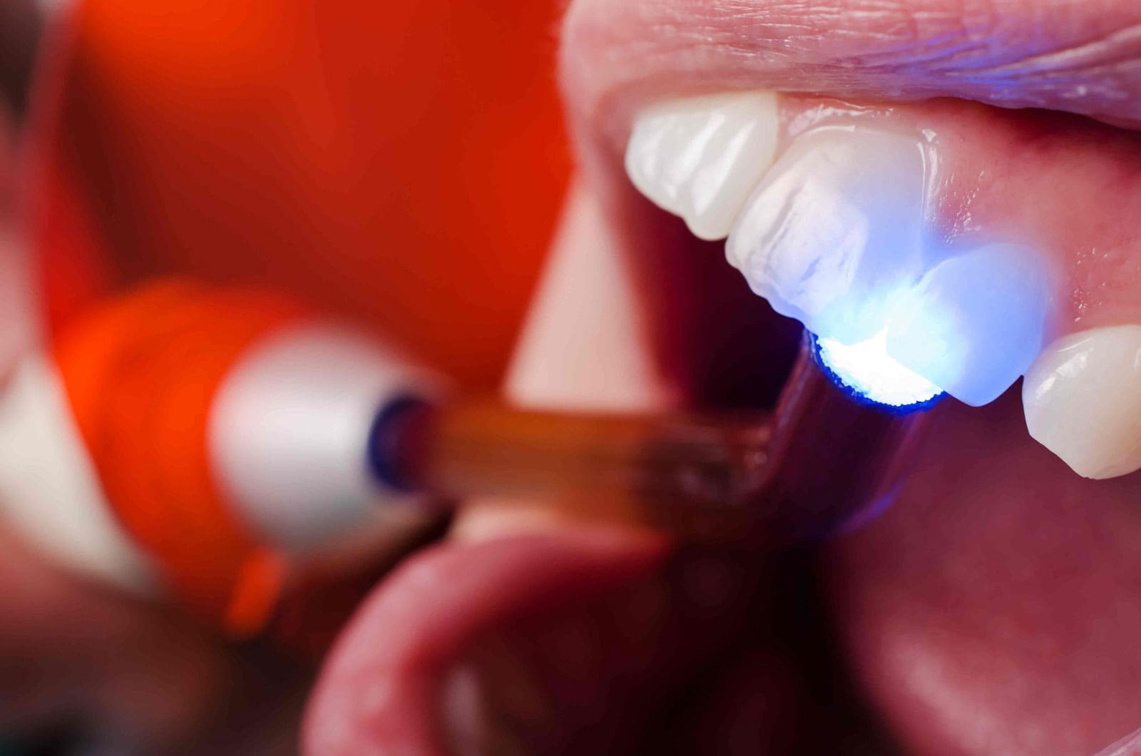 Tooth Sensitivity After Fillings What’s Normal and What’s Not
