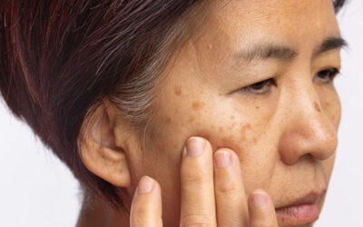 What Daily Skincare Routine Helps with Melasma?