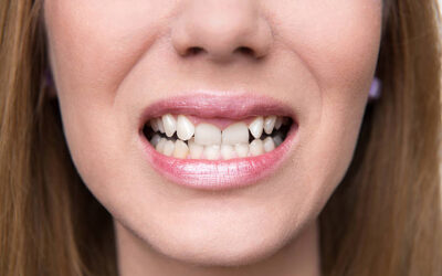Using 3D Imaging for Precise Overlapping Teeth Treatment Planning