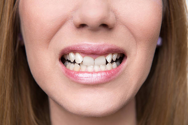 Using 3D Imaging for Precise Overlapping Teeth Treatment Planning
