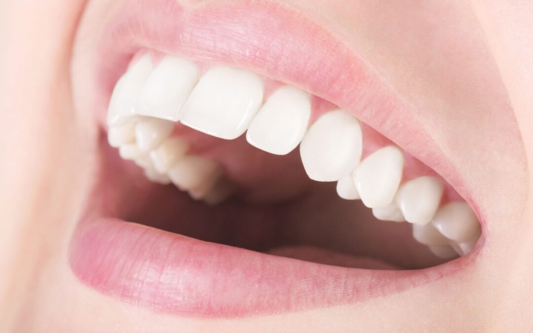 What Happens If a What Happens If a Composite Veneer Chips or Breaks? Chips or Breaks?