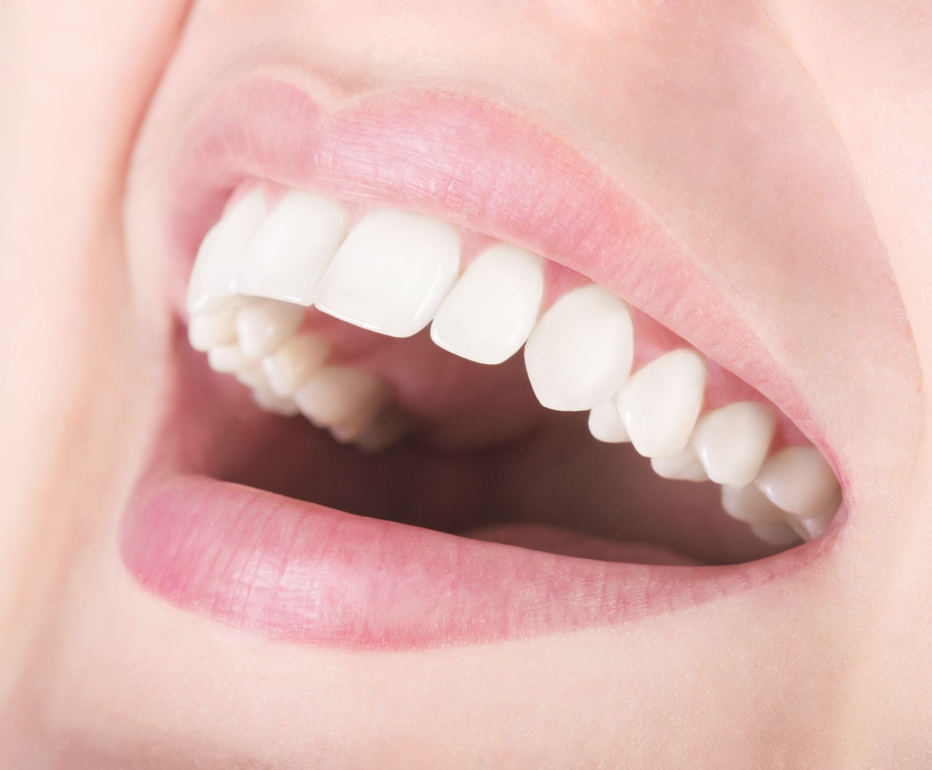 What Happens If a Composite Veneer Chips or Breaks