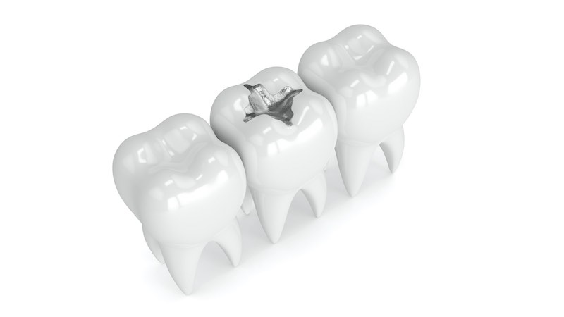 What Is an Amalgam Filling Everything You Need to Know