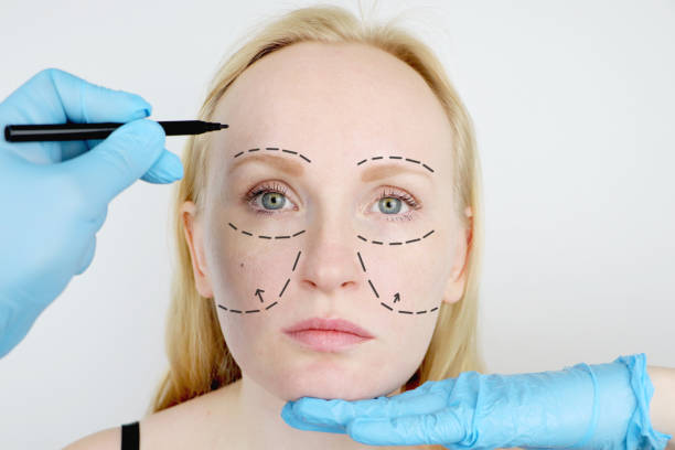 What Makes Facelift  So Popular