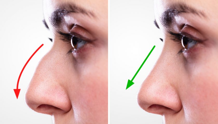best rhinoplasty in islamabad