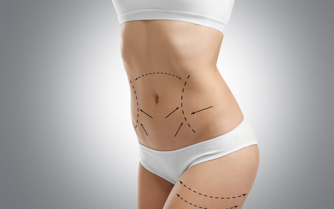 Liposuction Surgery for Men: What You Should Know