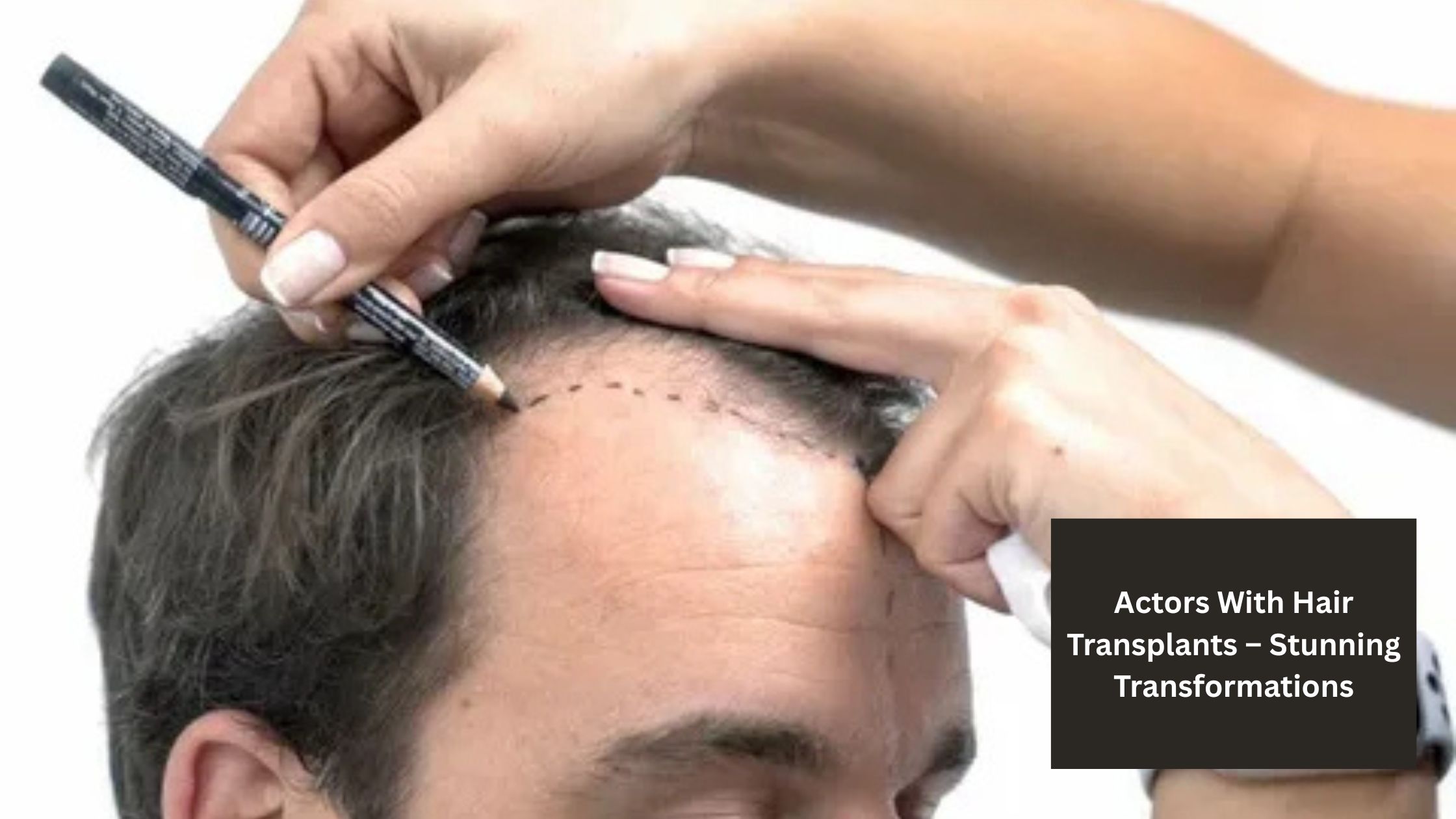Actors With Hair Transplants – Stunning Transformations