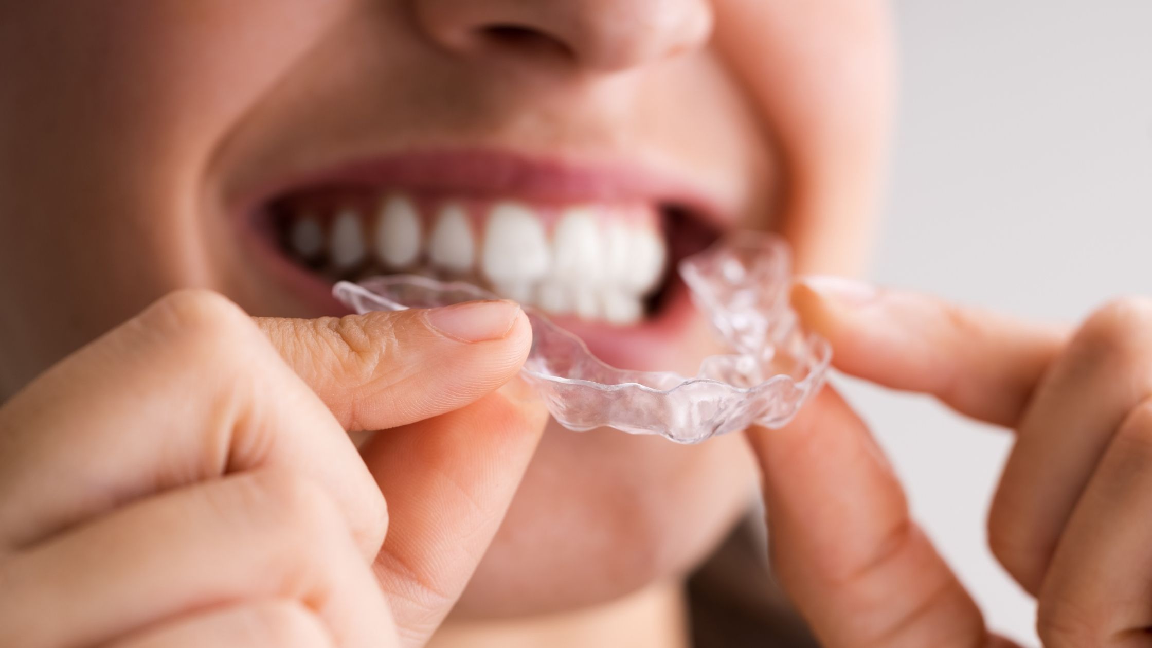 Aligner Technology Innovations Changing Orthodontics in 2025
