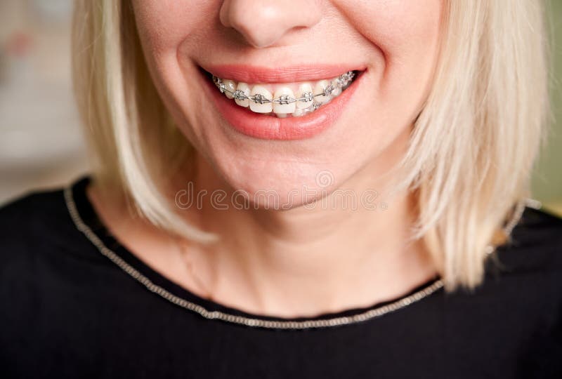 Braces and Self-Confidence The Emotional Side of Treatment