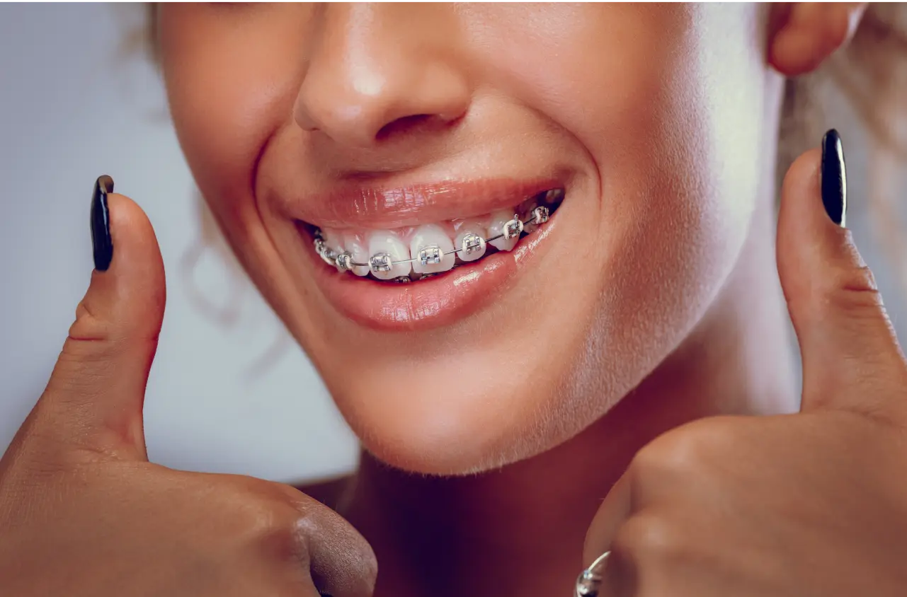 Can You Still Whiten Teeth with Metal Braces On