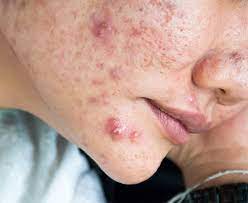 Can Acne Treatment Improve Skin Texture?