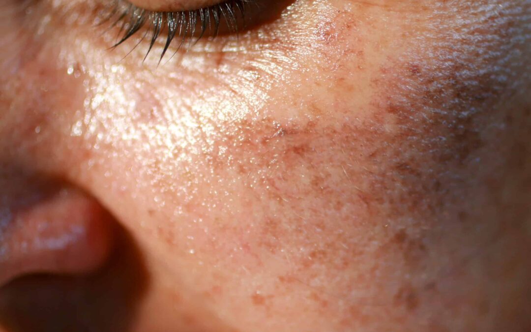 How to Treat Melasma with Skin Therapies?