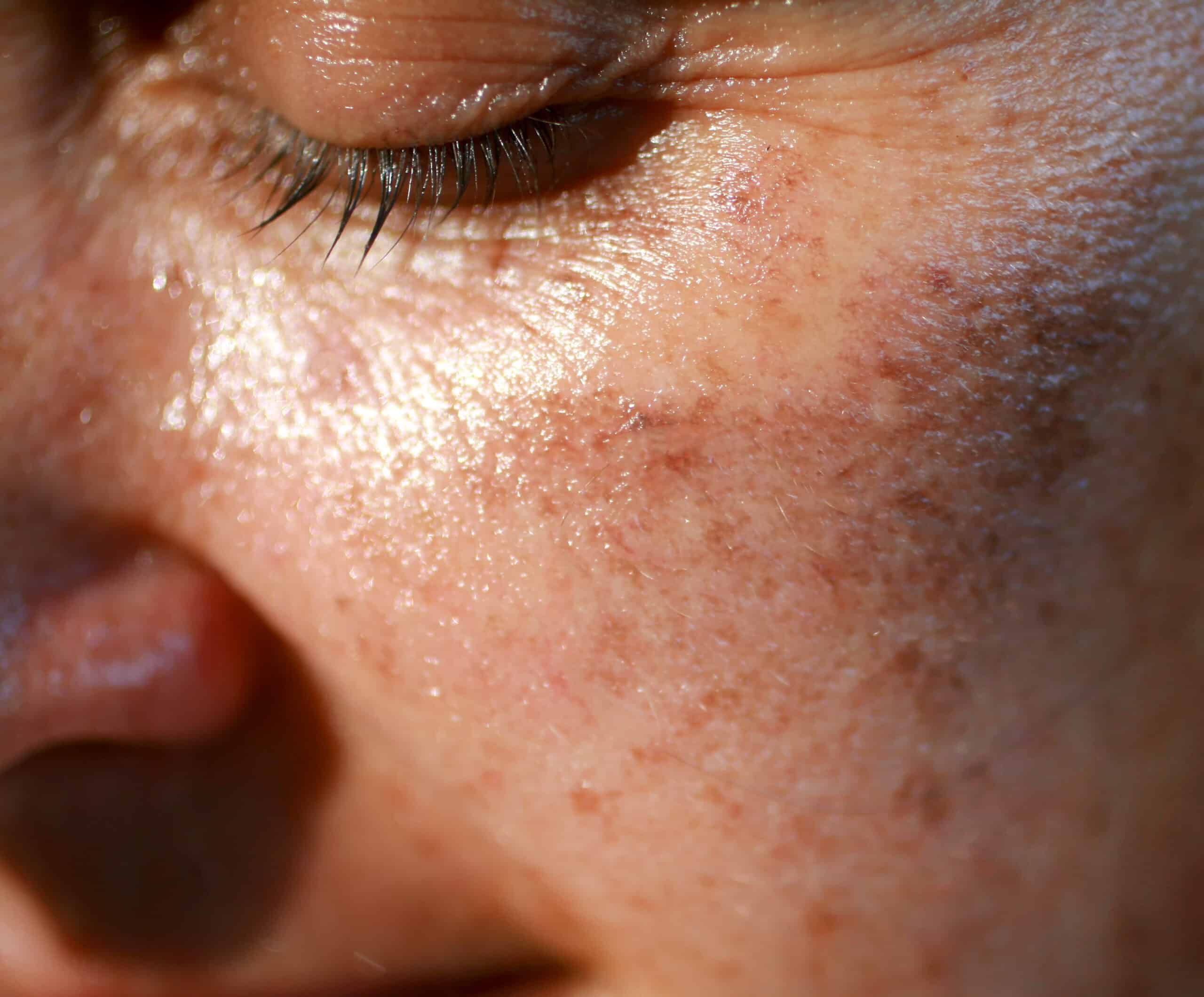 Clear skin starts here
