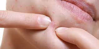 Combining Acne Treatment with Scar Removal