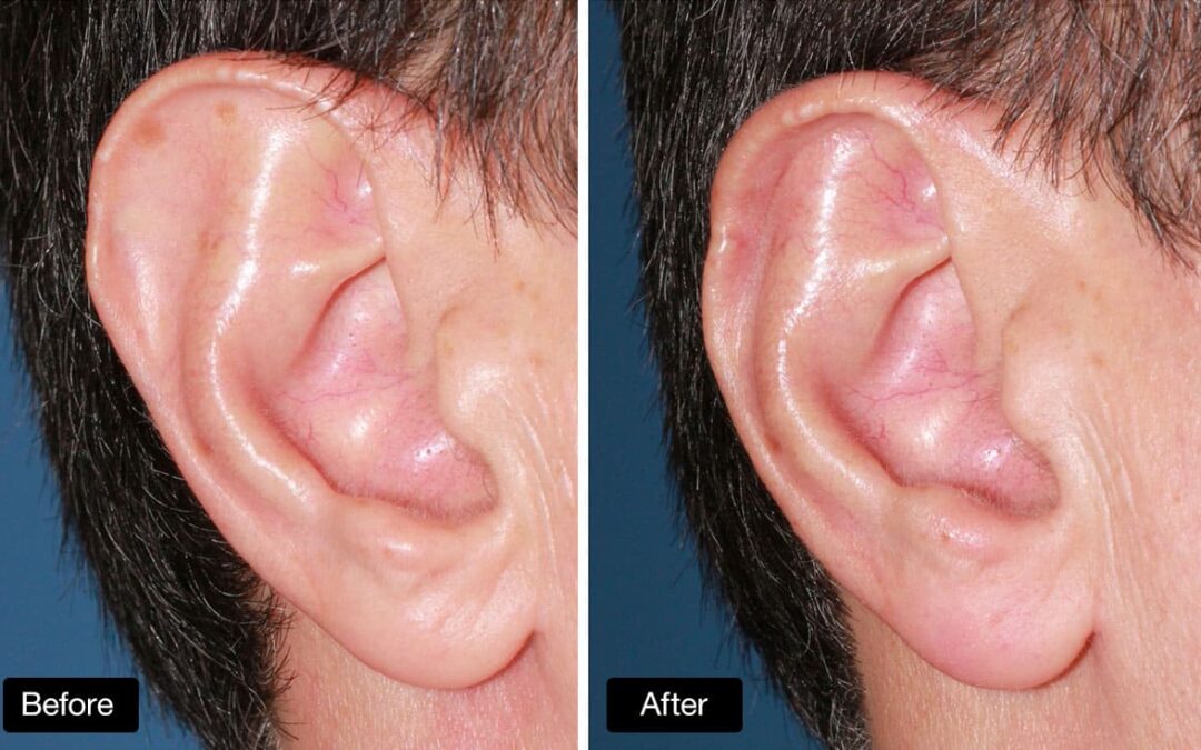 Can Ear Reshaping Surgery Help with Birth Defects?