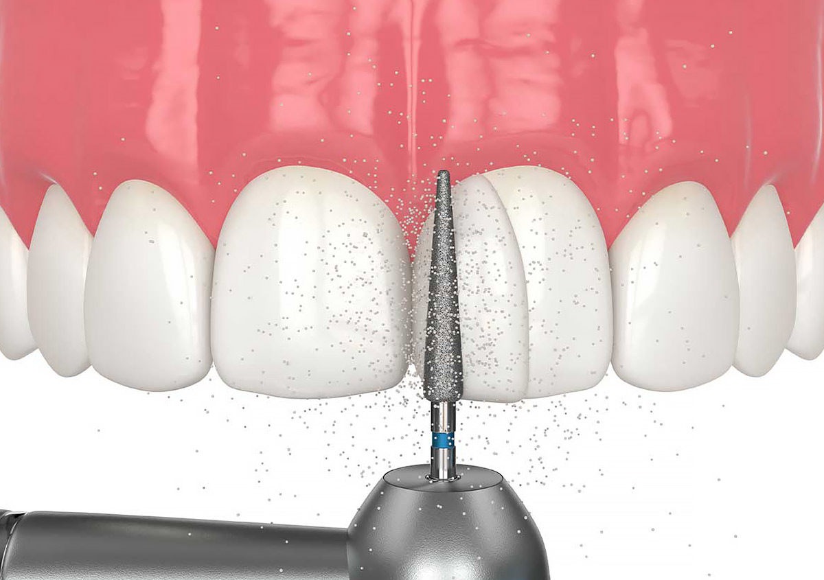 Dental Bonding Techniques Traditional vs. Modern Methods