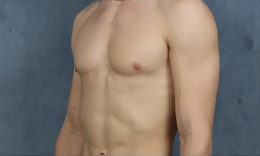 Discover Minimally Invasive Gynecomastia Surgery