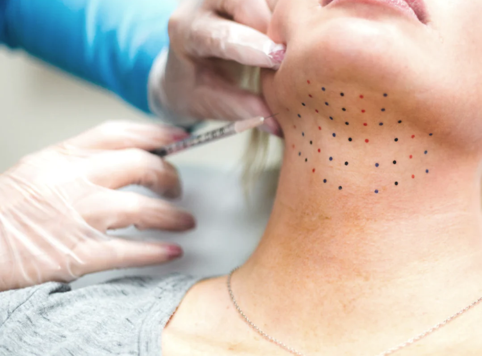 Does Mesotherapy Work for Double Chin Removal