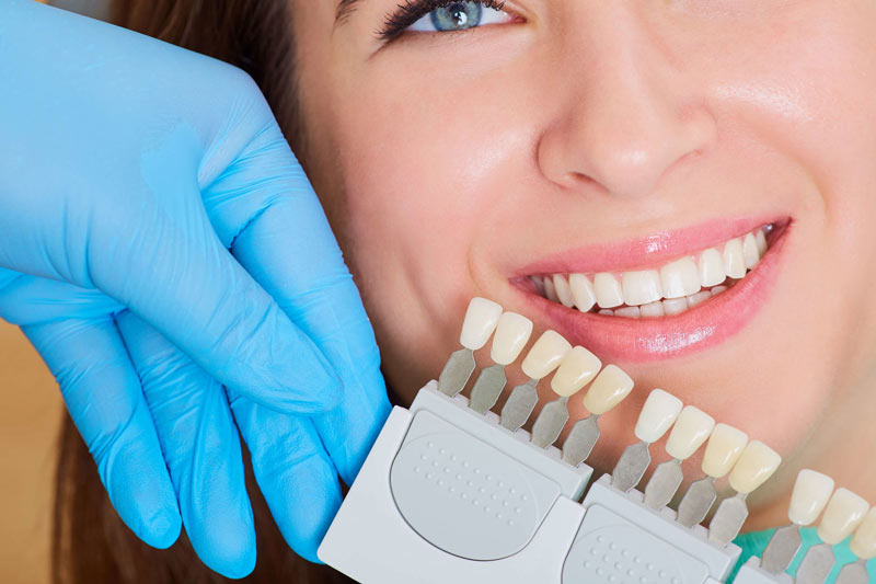 E-Max Veneers for Discolored Teeth: A Life-Changing Solution
