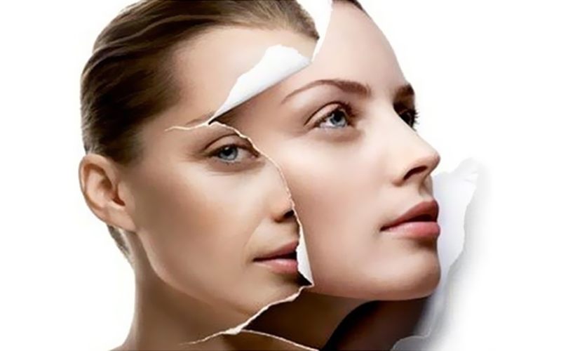 Fotona 4D Facelift Treatment Combining Four Laser Technologies