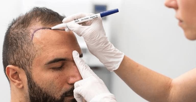  زراعة الشعر في الرياض