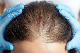 Hair density boost now